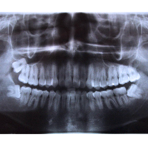 Ortopantomografía en Madrid  Radiología Dental Majadahonda  al precio de 29€
